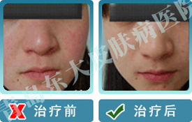臨沂皮膚病醫(yī)院哪家好