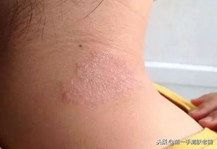 患了牛皮癬 吃這個(gè)食品,對(duì)牛皮癬的康復(fù)很有幫助