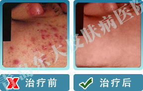 山東治療毛囊炎較好的醫(yī)院