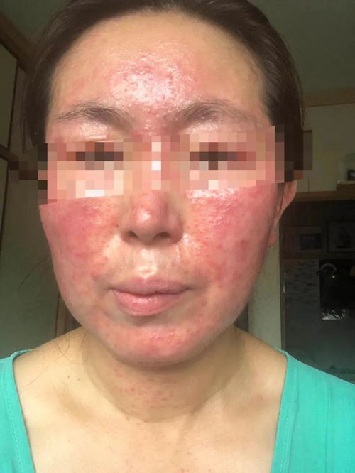 廣州中醫(yī)名醫(yī)皮膚病研究院 激素依賴性皮炎,除了停用激素,還要怎么辦