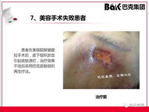 一切皮膚病及外傷的克星,傳統文化義工的事業 巴克產品介紹