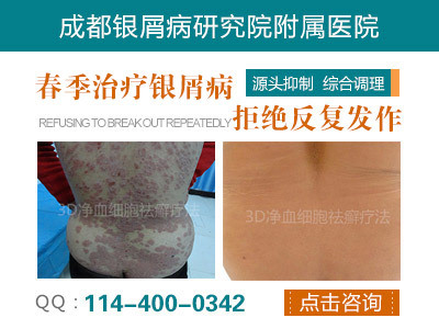彭州市人民醫院銀屑病專科_健康頻道