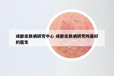 成都皮膚病研究中心 成都皮膚病研究所最好的醫生