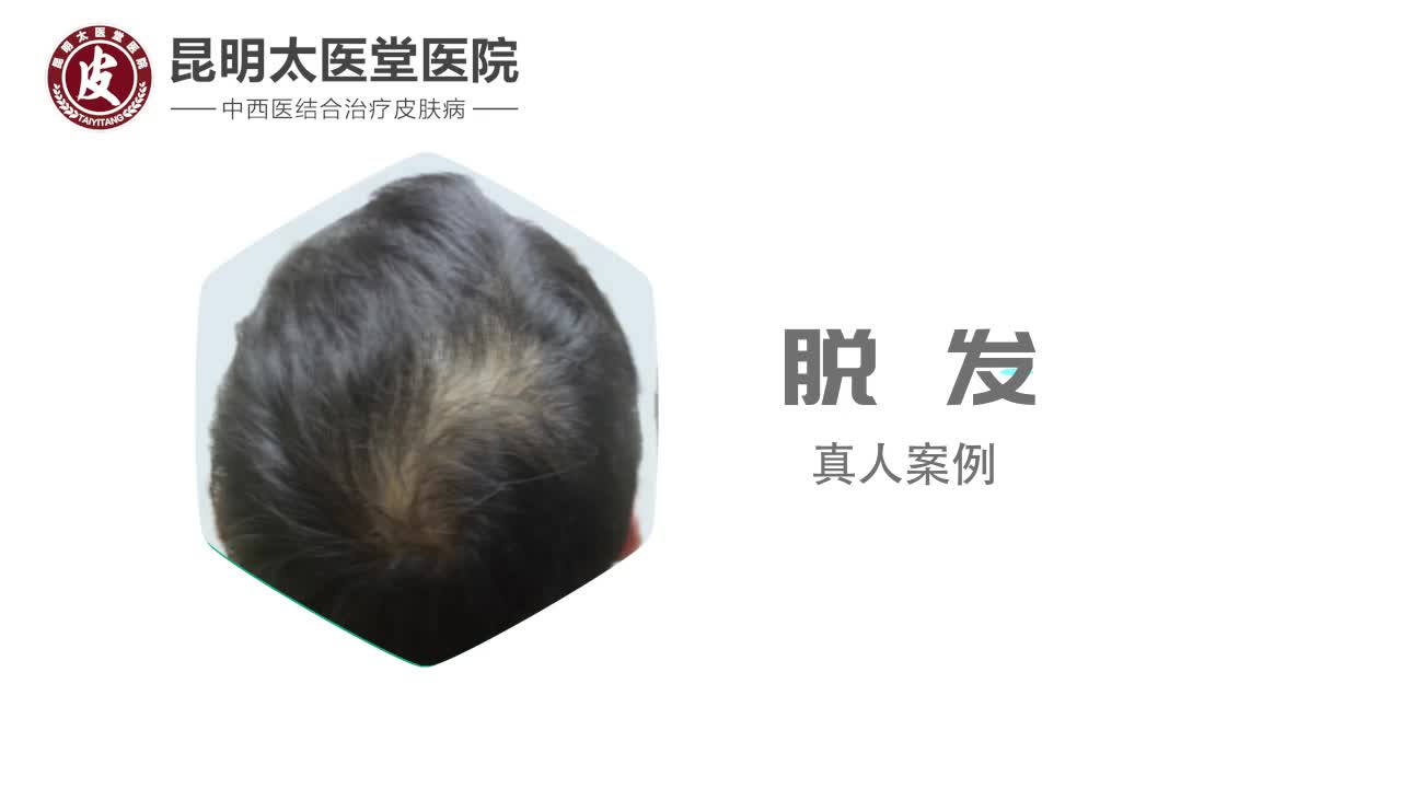 昆明太醫堂皮膚病研究院:治好脫發,自信生活