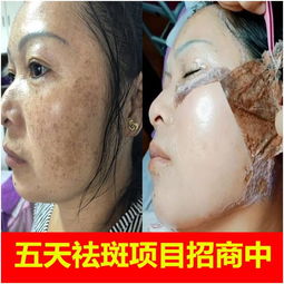 五天祛斑加盟廢多少錢,祛斑揭膜好用嗎,十八專業祛斑招商總部