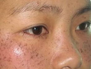 去黃褐斑多年未果,嘗盡各種辦法都無效,其實去它就應該用專業祛斑產品