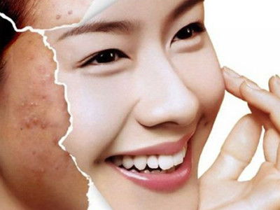 五天祛斑祛痘中心 分析一下為什么皮膚管理越來越流行