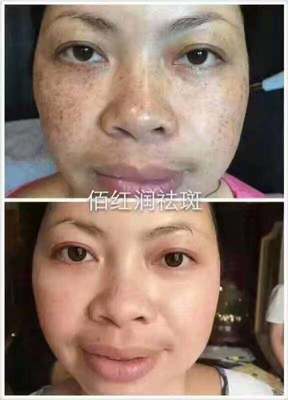 佰紅潤(rùn)一次性祛斑專(zhuān)家